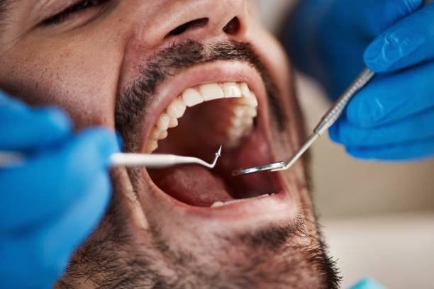 Best Urgent Care for Lost Fillings or Crowns in Wauseon, OH